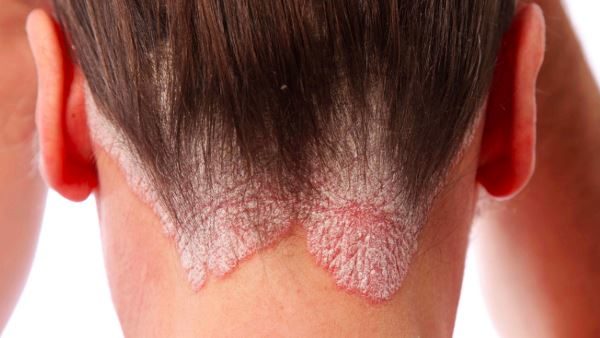 psoriasi 3