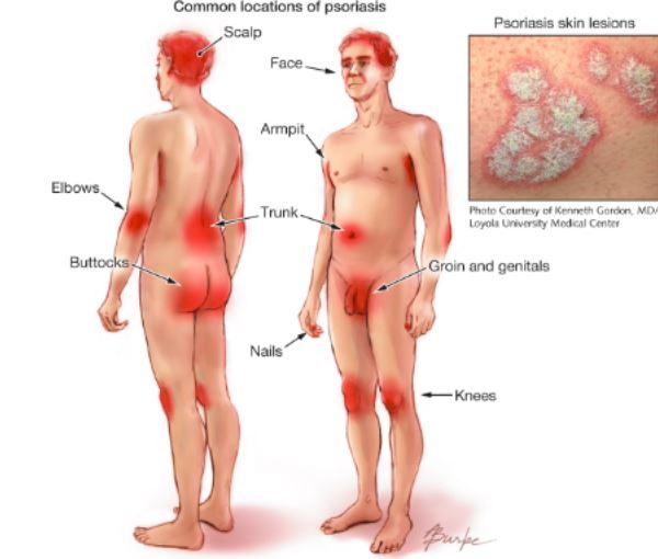 psoriasi e disfunzione erettile