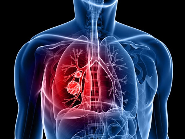 carcinoma polmonare