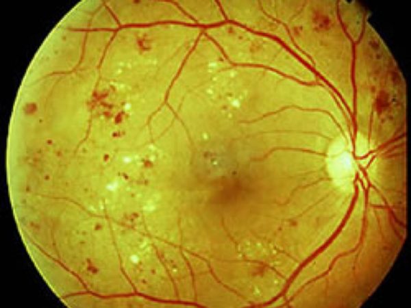 Fundus oculi: retinopatia diabetica con essudati ,emorragie e microaneurismi