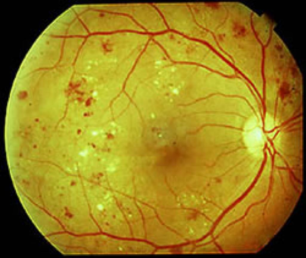 Fundus oculi: retinopatia diabetica con essudati ,emorragie e microaneurismi