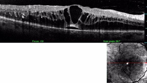 Oct: edema maculare diabetico